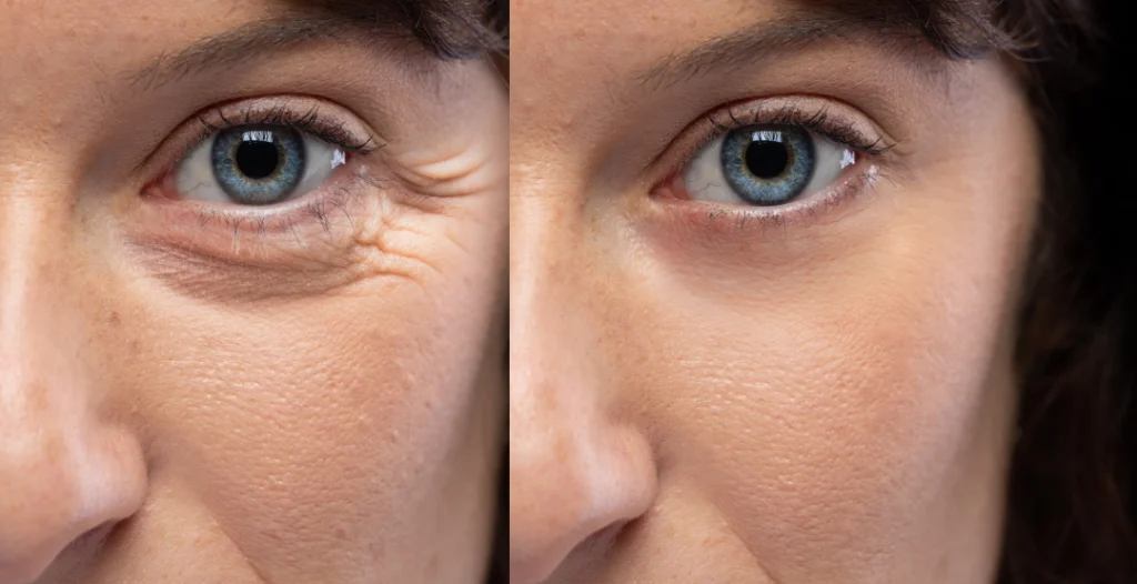 Before and after Botox treatment showing reduced wrinkles around the eyes.