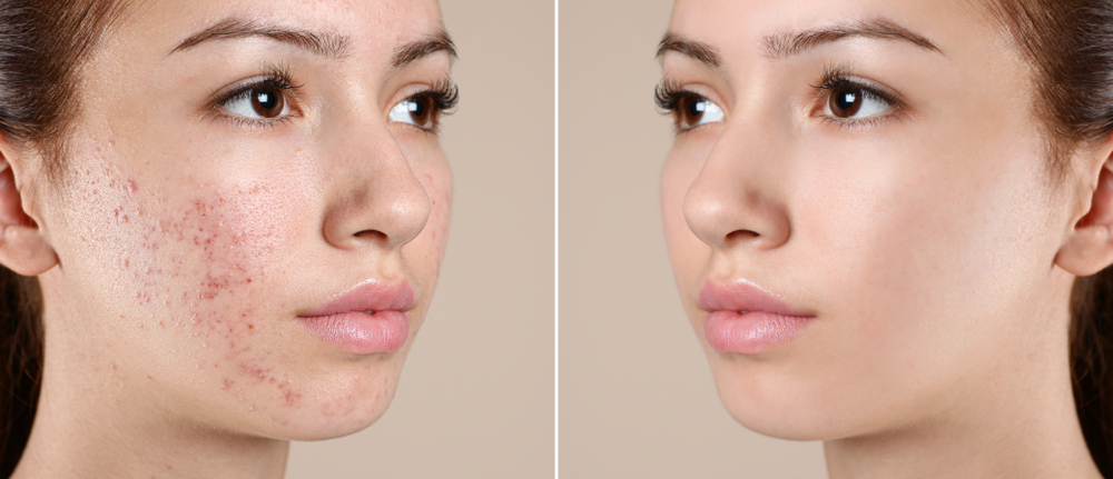 Before and after results showcasing the effectiveness of Morpheus8 on acne scars.