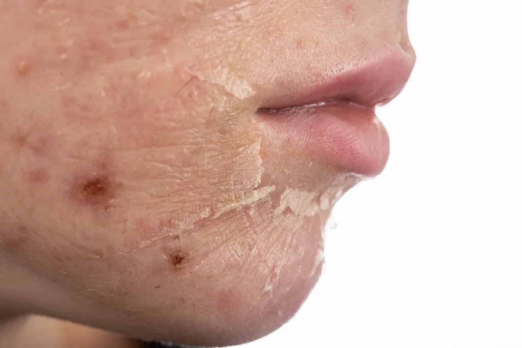 Close-up of peeling skin after a chemical peel treatment.