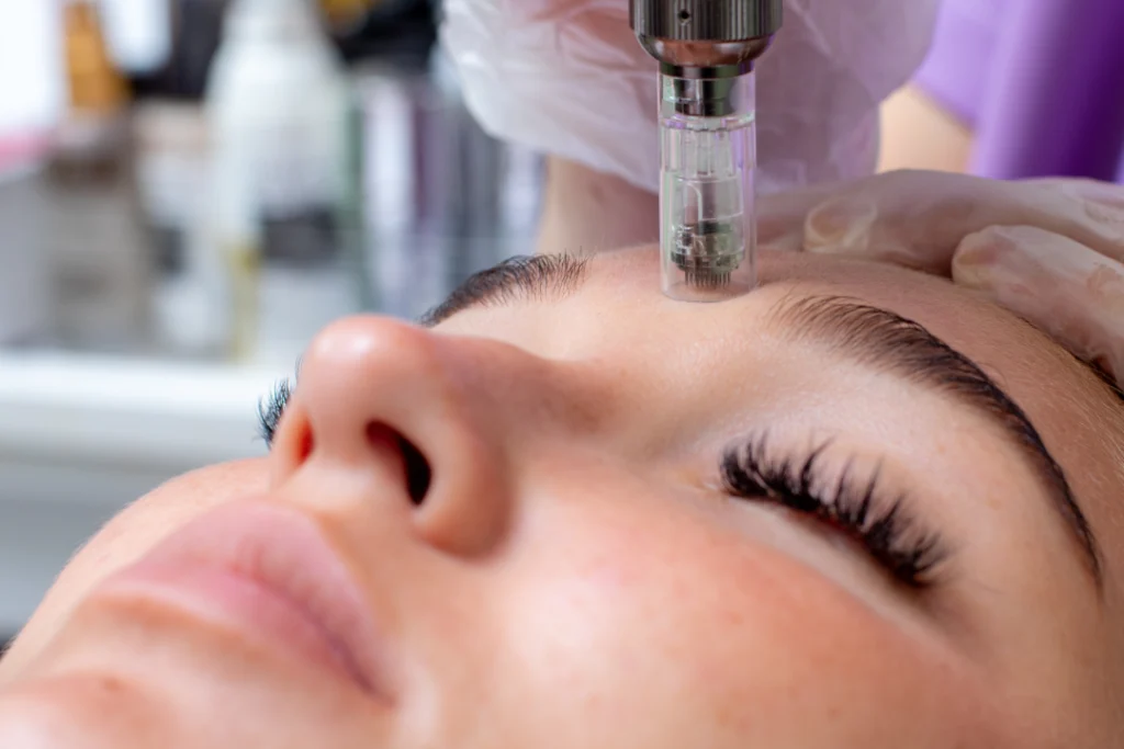 A close-up of a SkinPen microneedling session for facial rejuvenation.