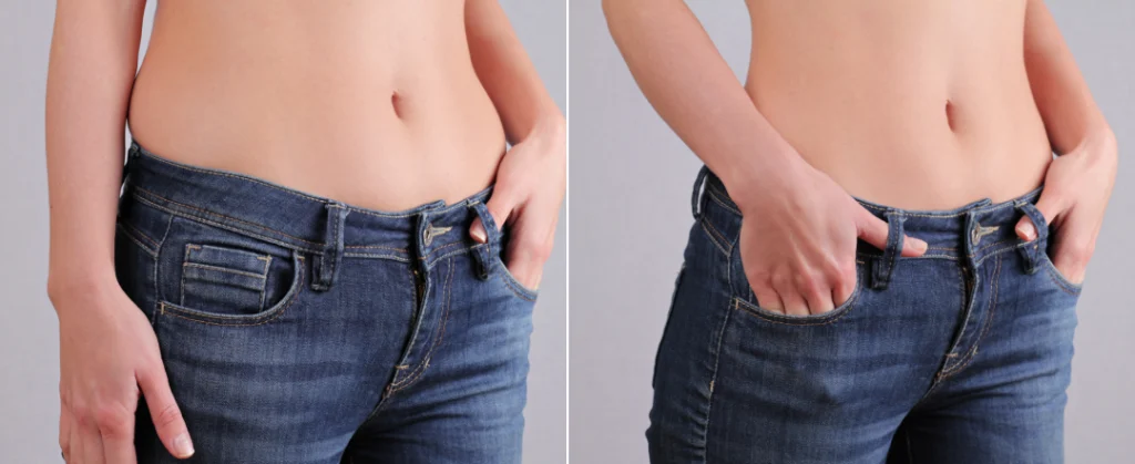 A before-and-after comparison of a woman’s waistline, showcasing body sculpting results from a medspa treatment.